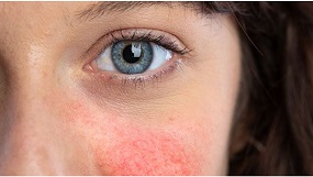 Problematická pleť